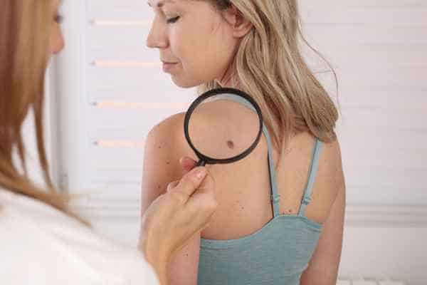 What Are Traditional Skin Lesion Removal Methods Hastings?