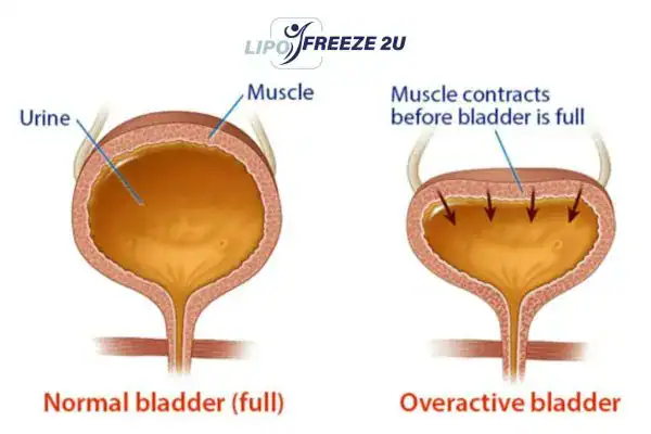 diagram of overactive bladder treatment Hastings