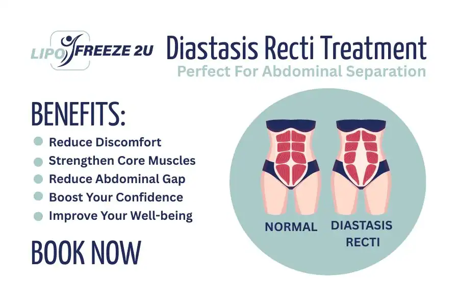 How Long Will It Take to See Improvements in Diastasis Recti Hastings