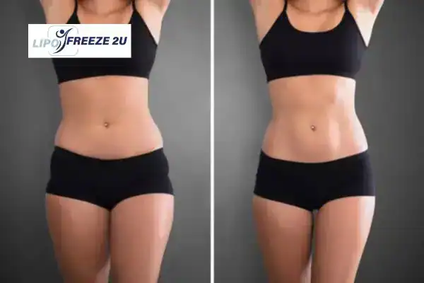 How Can LIPO FREEZE 2U Support Your Post-Pregnancy Body Recovery Hastings?