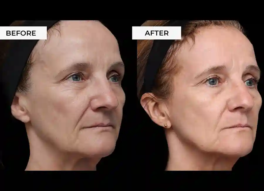 How Many RF Microneedling Sessions Will You Need to See a Difference Hastings?