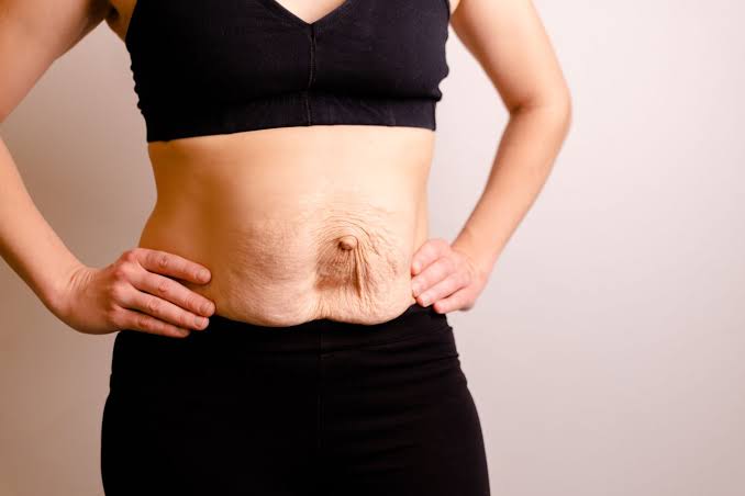 Is Surgery Really the Only Way to Repair Diastasis Recti Hastings?