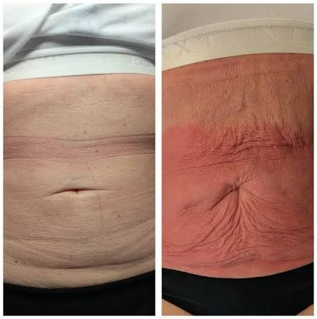 How Does RF Microneedling Improve Crepey, Thin and Uneven Skin Texture Hastings?