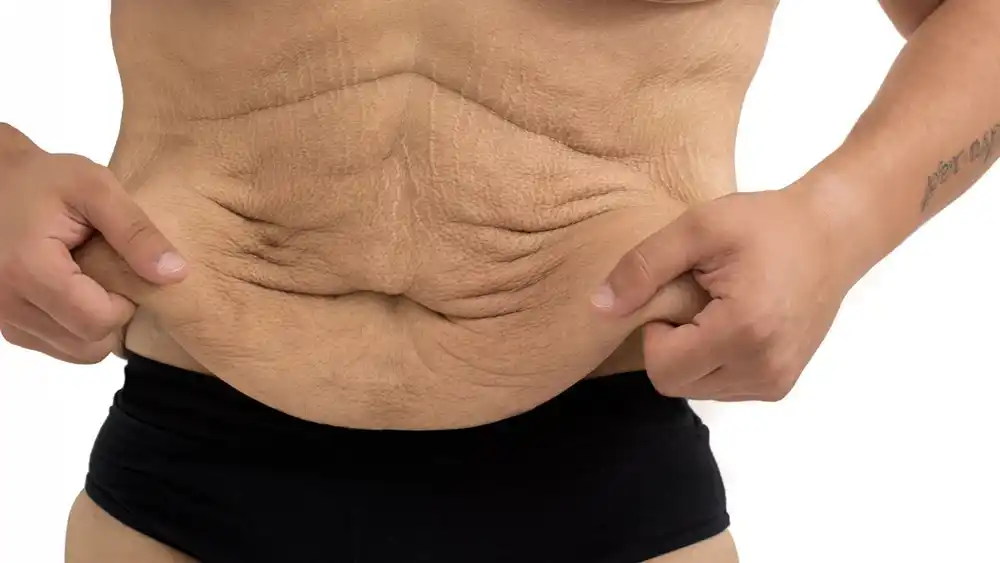 RF Microneedling for Loose Skin: How Can It Help Tighten and Reshape the Skin Hastings?